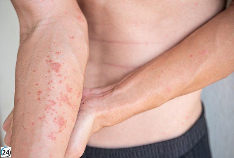 Hospital de Toledo lanza programa de formación exclusiva sobre dermatitis atópica para médicos de Atención Primaria